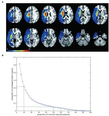 A precise language network revealed by the independent component-based lesion mapping in post-stroke aphasia